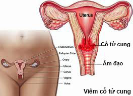 Nguyên nhân gây Viêm Cổ tử cung