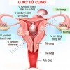 Biểu hiện của u xơ cổ tử cung