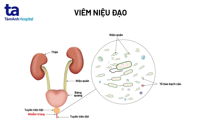 viêm niệu đạo là gì