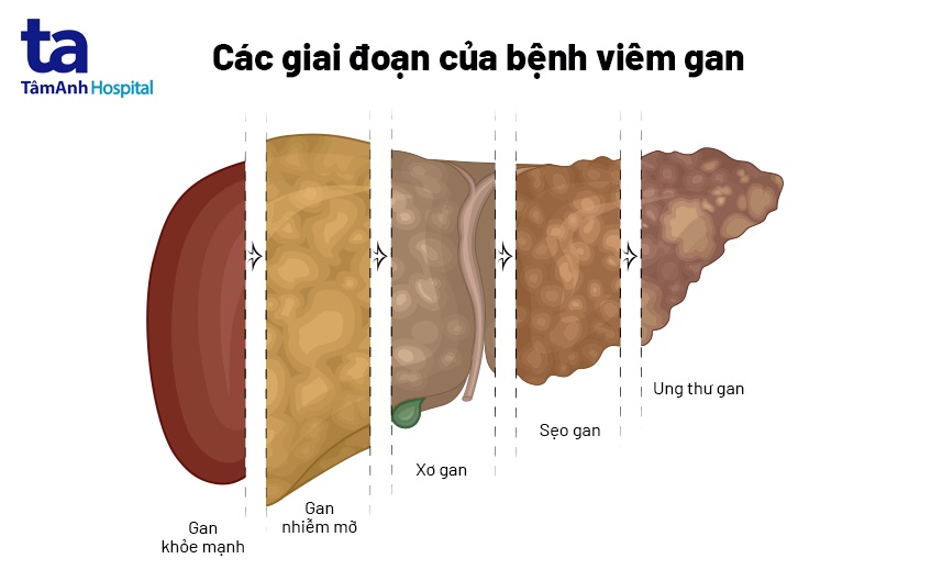 các giai đoạn của viêm gan
