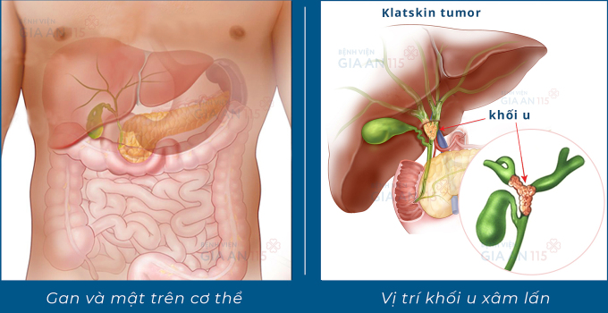 Hình ảnh minh hoạ ung thư đường mật vùng rốn gan, còn gọi u Klatskin. Ảnh: Bệnh viện mang lại