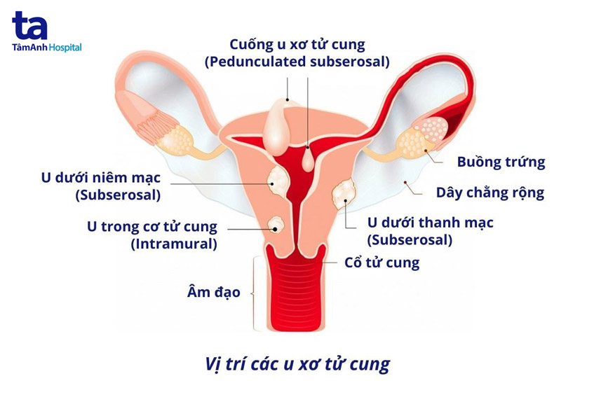 vị trí các khối u xơ trong tử cung