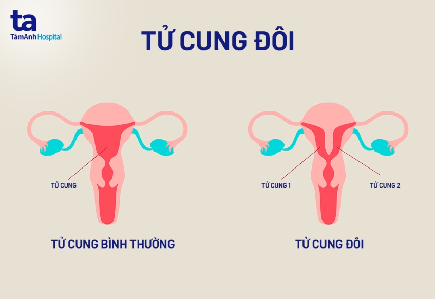 bất thường về tử cung
