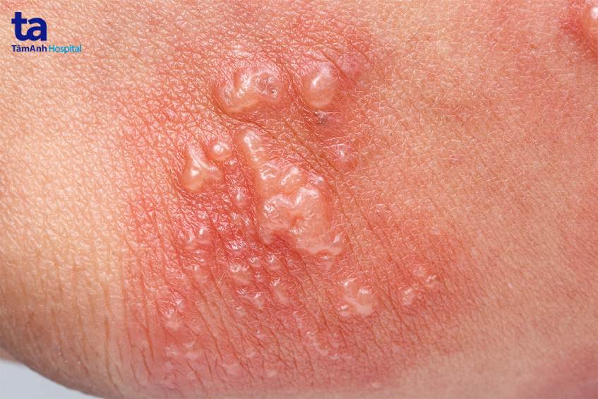triệu chứng sùi mào gà ở nữ