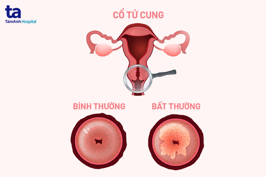 cổ tử cung bình thường và bất thường