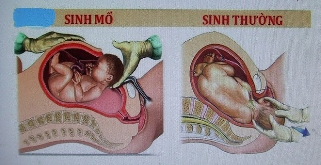 sinh-mo-va-sinh-thuong