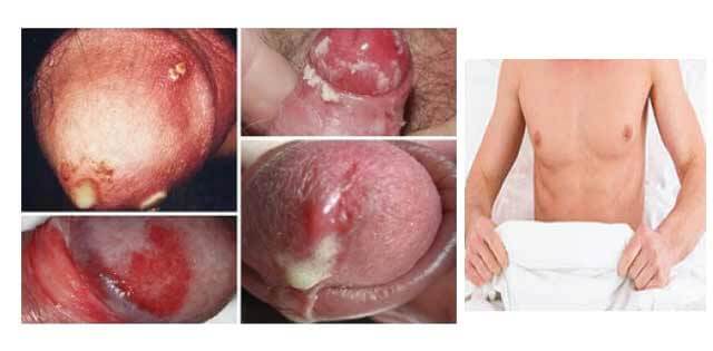 Cậu nhỏ bị sưng 3