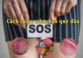 Cậu nhỏ bị sưng 2