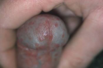 Cậu nhỏ bị sưng 7