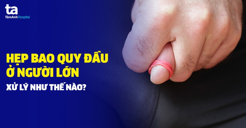hẹp bao quy đầu ở người lớn