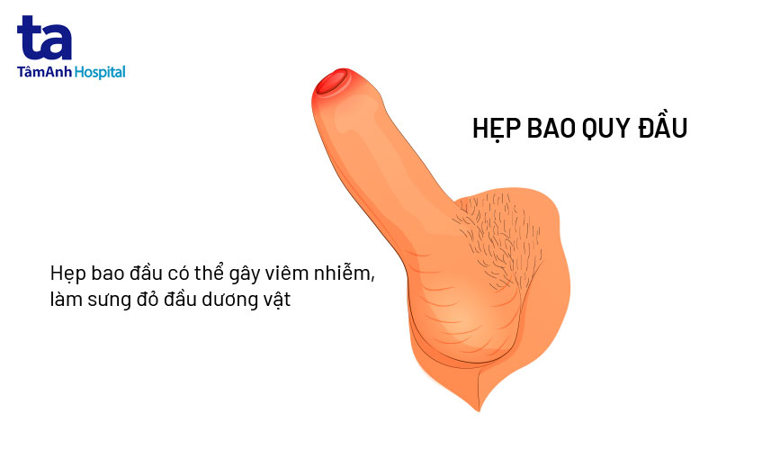 hẹp bao quy đầu ở người lớn như thế nào