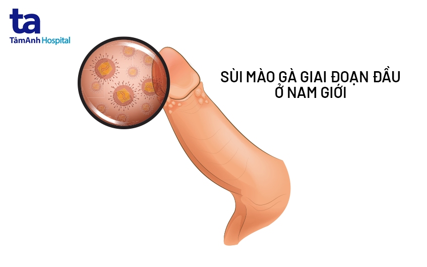 Hình ảnh mắc sùi mào gà giai đoạn đầu ở nam giới