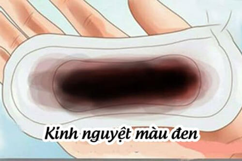 Cách chữa kinh nguyệt màu đen 1