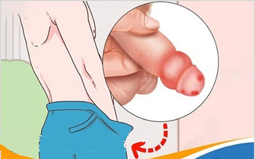 Cậu nhỏ bị sưng