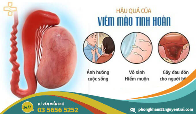 Hình ảnh viêm mào tinh hoàn
