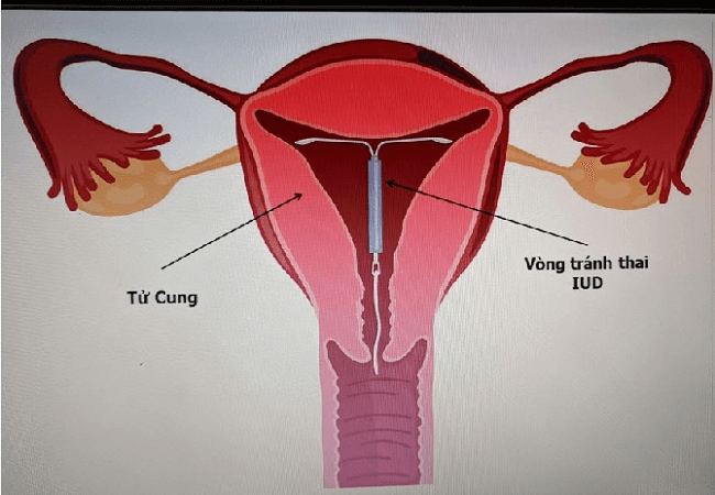 đặt vòng tránh thai