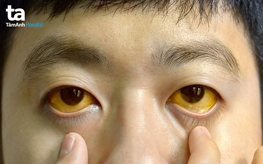 triệu chứng của bệnh viêm gan