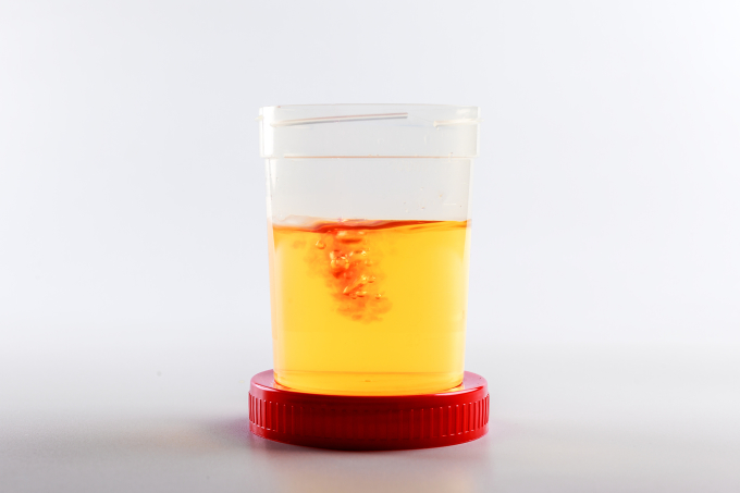 Nước tiểu lẫn máu có thể là dấu hiệu cảnh báo viêm thận bể thận. Ảnh: Shutterstock
