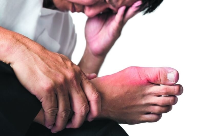 Bệnh gout hay gây ra các cơn sưng đau và viêm ở các khớp, thường gặp nhất là ngón chân cái. Ảnh: Diag