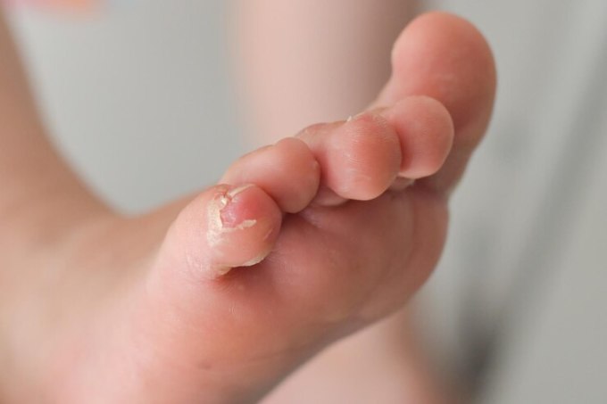 Bong tróc da ở trẻ sơ sinh có thể là dấu hiệu của bệnh giang mai. Ảnh: Freepik