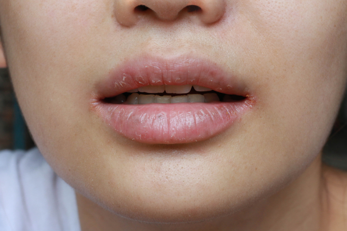 Khô miệng không được điều trị kịp thời có thể gây nhiễm trùng hệ răng miệng. Ảnh: Shutterstock
