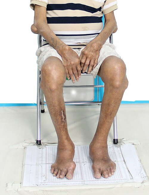 Tay chân bệnh nhân nổi nhiều cục tophi, đau nhức, suy kiệt, khi mới nhập viện điều trị. Ảnh: Viện Gút