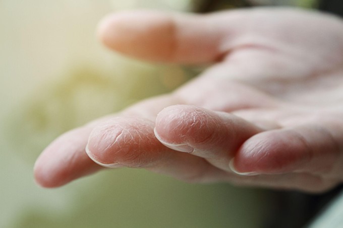 Nôn ói nhiều gây mất nước, da khô, dẫn đến biến chứng rối loạn điện giải. Ảnh: Shutterstock