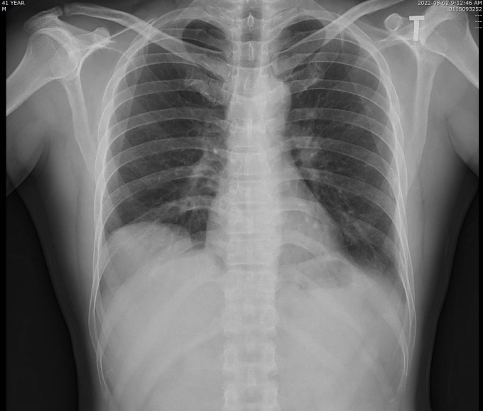 Hình ảnh X-quang phổi của bệnh nhân bị nhão cơ hoành khiến tạng dưới ổ bụng di chuyển lên trên gây xẹp thùy dưới phổi phải. Ảnh: Bệnh viện cung cấp