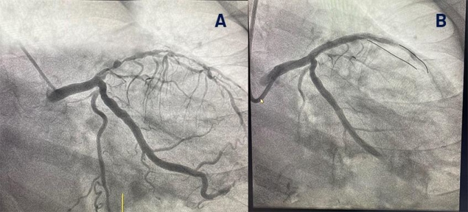 Hình ảnh chụp DSA mạch vành trước khi nong (A) và sau khi nong mạch liên thất trước (B) của bệnh nhân. Ảnh: Bệnh viện Đa khoa Tâm Anh