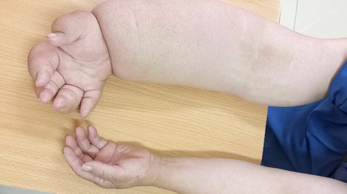 Biến chứn sau điều trị ung thư vú khiến bàn tay bệnh nhân sưng to, phù nề. Ảnh: Bệnh viện cung cấp