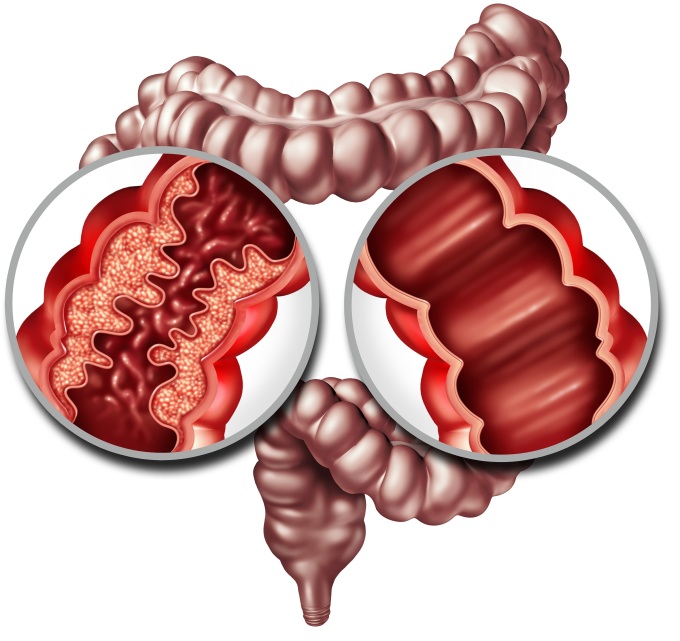 Đường ruột không thông thoáng do khối u hoặc sẹo (trái) và ruột khỏe mạnh (phải). Ảnh: Shutterstock