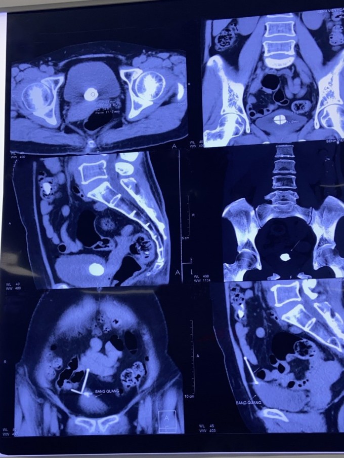 Hình ảnh X-quang thể hiện chiếc vòng tránh thai đi lạc trong ổ bụng, bàng quang.