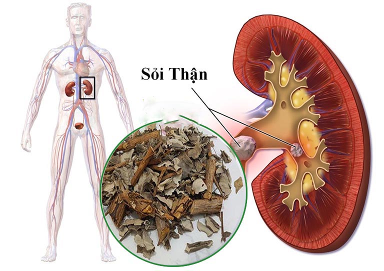 Cây từ bi trị bệnh sỏi thận