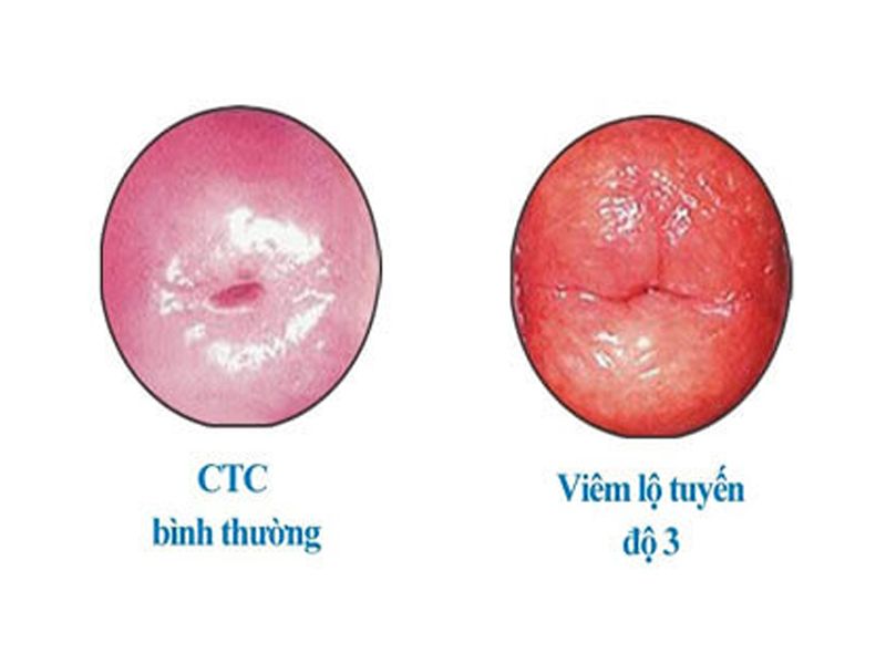 Hình ảnh viêm lộ tuyến cổ tử cung giai đoạn 3