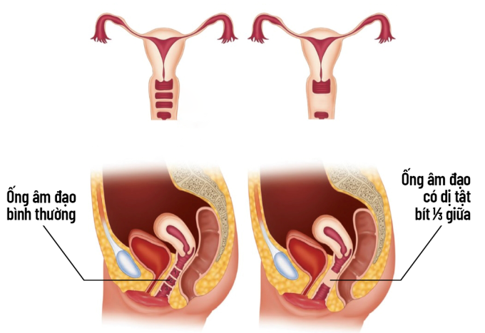 Bất sản âm đạo, cổ tử cung là loại dị dạng phức tạp hiếm gặp và gây nên biến chứng nghiêm trọng. Ảnh: Shutterstock