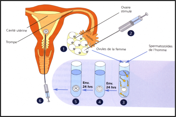 IVF - Thụ tinh ống nghiệm