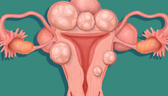 U xơ tử cung có mổ nội soi được không