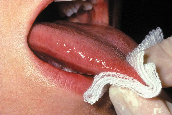 Tìm hiểu về bệnh mụn rộp sinh dục ở lưỡi