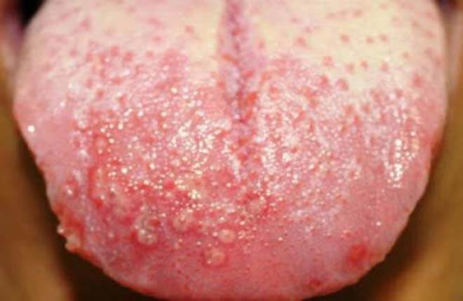 Mụn rộp sinh dục lưỡi: Triệu chứng và cách điều trị hiệu quả