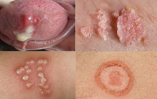 Bệnh lây qua đường tình dục