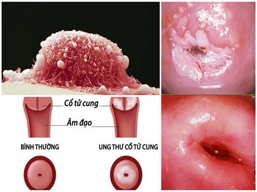Bệnh ung thư âm đạo và ung thư cổ tử cung