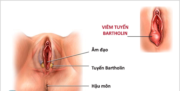 Viêm tuyến bartholin