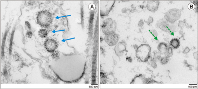 Cấu trúc tinh hoàn của bệnh nhân mắc Covid-19 quan sát dưới kính hiển vi điện tử cho thấy có sự hiện diện của nCoV (mũi tên màu xanh) trong các tiểu quản sinh tinh của tinh hoàn. Ảnh: The World Journal of Mens Health
