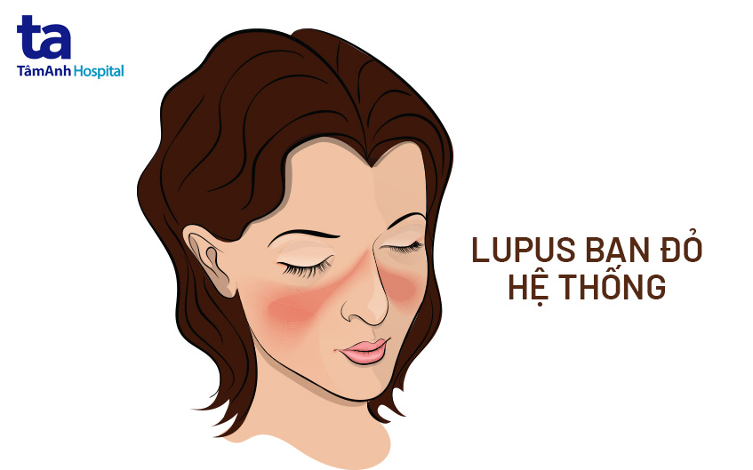bệnh lupus hệ thống