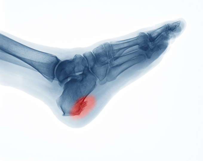 Gai gót chân gây đau đớn dữ dội khi đi lại, ảnh hưởng đến sinh hoạt hàng ngày. Ảnh: Shutterstock