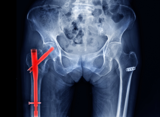 Tác động lực mạnh lên vùng khớp háng do té ngã là nguyên nhân thường gặp làm gãy cổ xương đùi và liên mấu chuyển xương đùi (vùng màu đỏ). Ảnh: Shutterstock