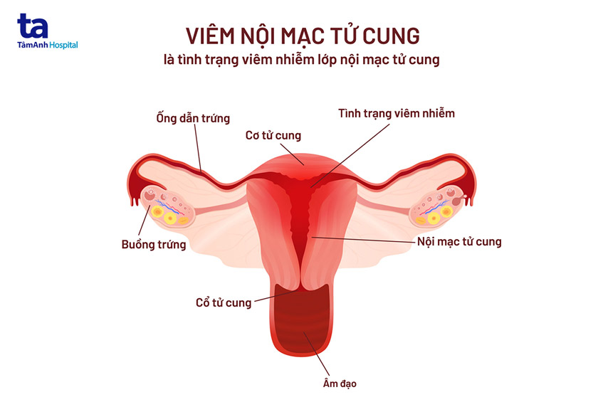 viêm nội mạc tử cung ở phụ nữ sau sinh