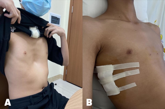 Hình ảnh cho thấy vùng giữa ngực của em Tuấn bị lõm sâu (hình A) và sau khi được phẫu thuật đặt thanh nâng ngực (hình B). Ảnh: Bệnh viện Tâm Anh