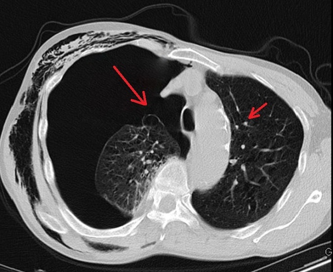 Phim chụp CT phổi của bệnh nhân cho thấy các kén khí (điểm trắng) ở phổi. Ảnh: Bệnh viện cung cấp
