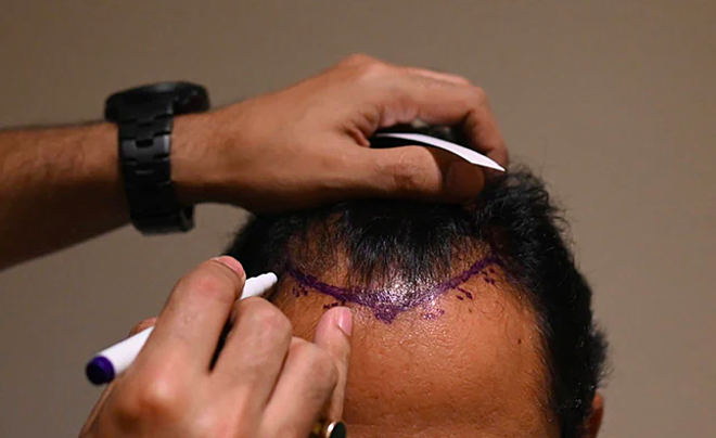 Một bác sĩ đang làm thủ thuật cấy tóc cho các bệnh nhân. Ảnh: NDTV